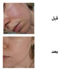سرم ضد جوش و جای جوش آزلائیک اسید ناین لس